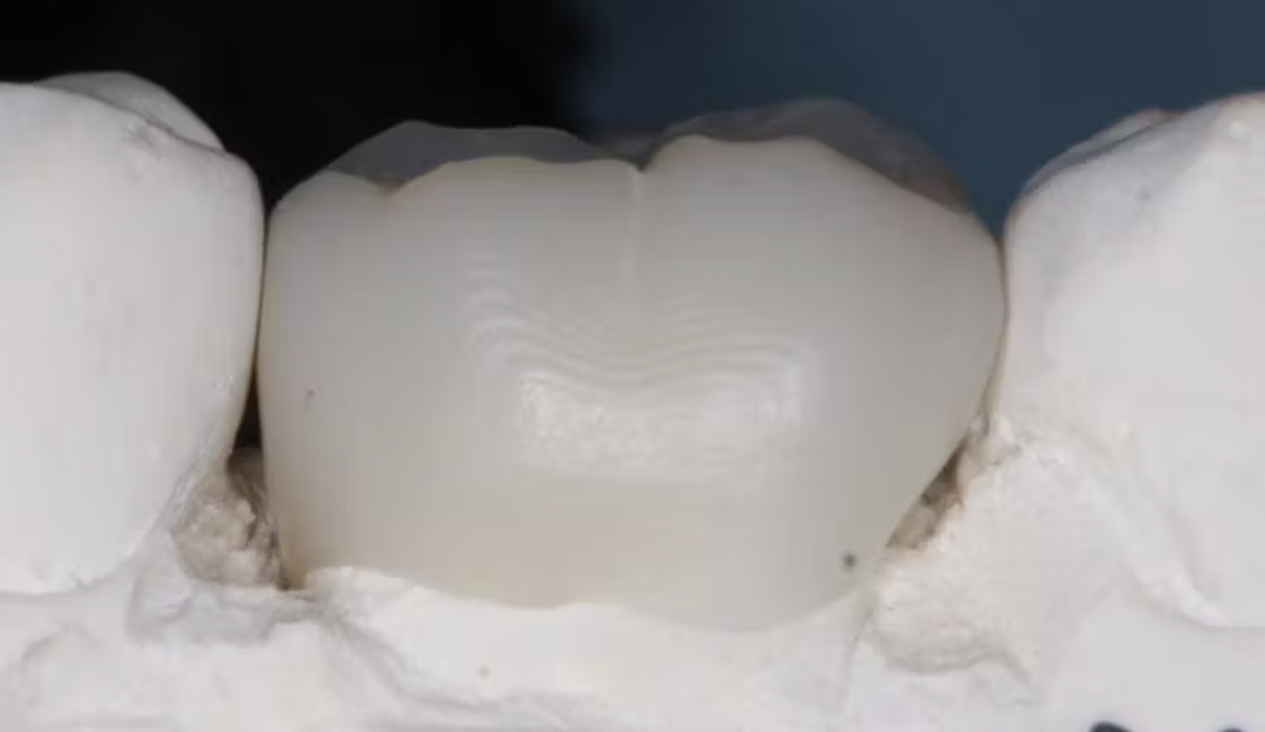 In 3D răng sứ đang phát triển mạnh: Liệu công nghệ này có phù hợp với phòng khám của bạn?